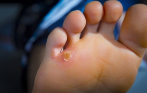 Understanding Seed Corns on the Foot