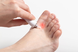 Diagnosis of Athlete’s Foot
