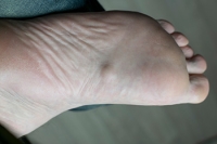 Facts About Plantar Fibroma